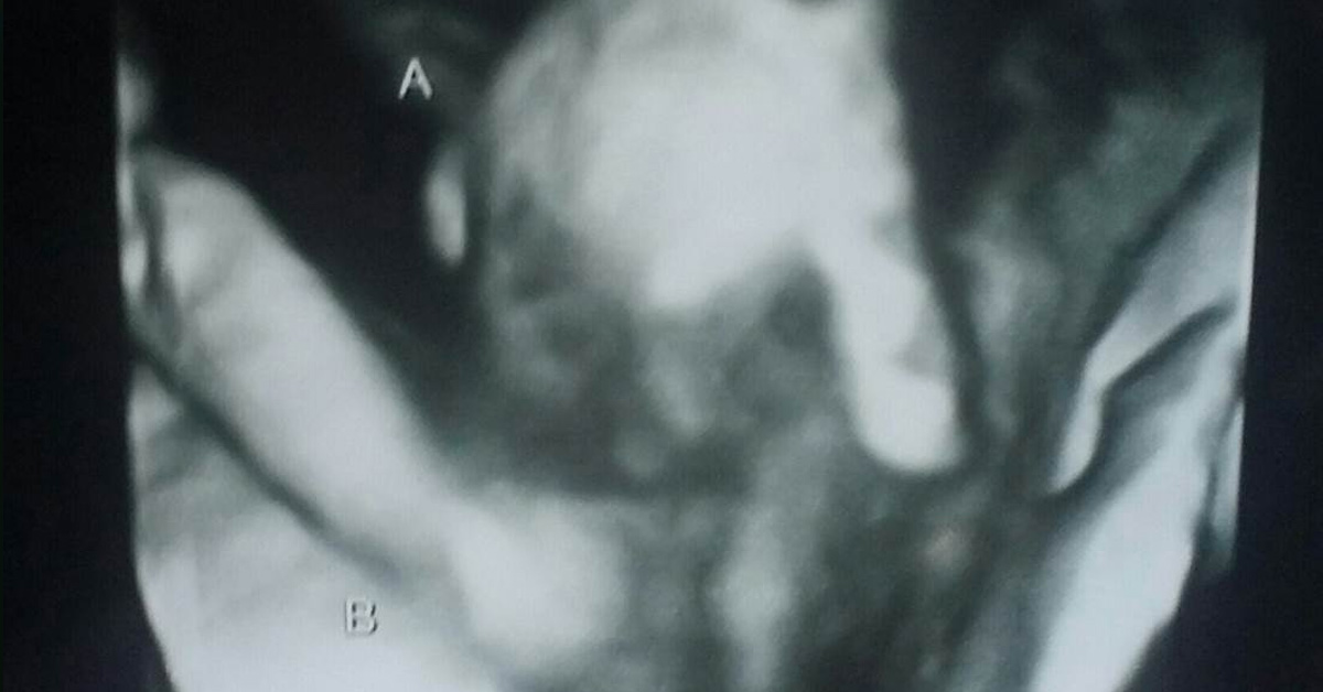 Ultrasound Reveals Sister Holding Dying Twin’s Hand In Womb